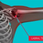 labraltear-shoulderpain-labra-physiotherapy-mississauga-etobicoke