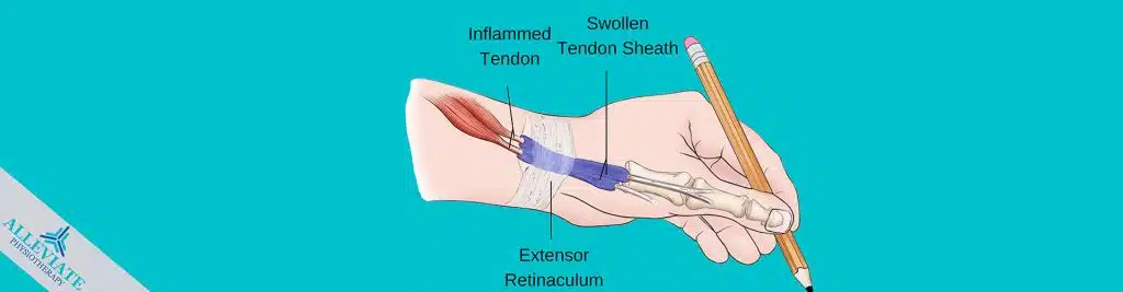De-Quervains-Tenosynovitis-hand-and-wrist-pain-physiotherapy-etobicoke-mississauga