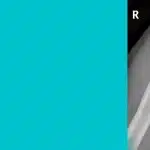 Rotator-cuff-injury-shoulder-pain-etobicoke-mississauga