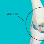 mcl tear ligament injury knee Physiotherapy
