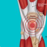 patellar-tendonitis-kneepain-physiotherapy-etobicoke-mississauga