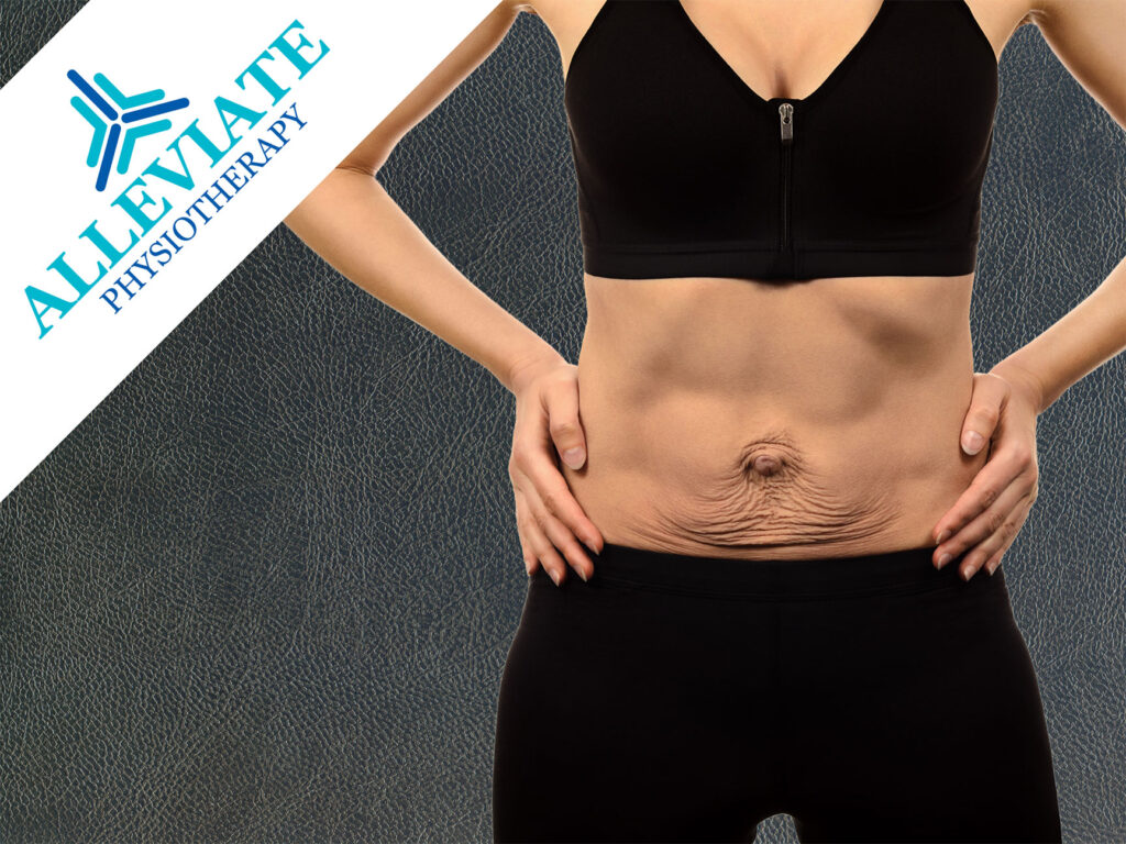 Best Physiotherapy for Diastasis Recti Relief in Calgary!