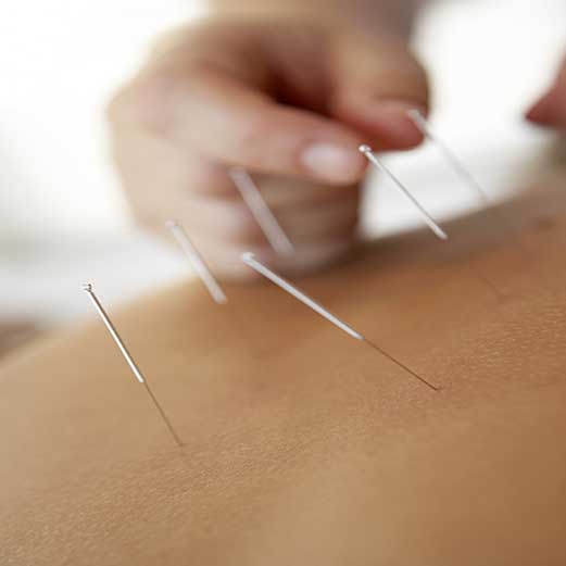 dry needling