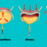 Urge-Incontinence-pelvicfloor-pelvichealth-pelvicpain-mississauga-etobicoke