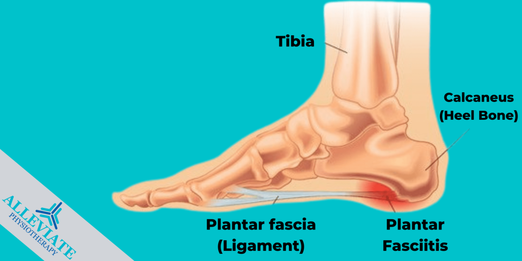 heelspurs-heelpain-plantar-fasciitis-physiotherapy-mississauga-etobicoke