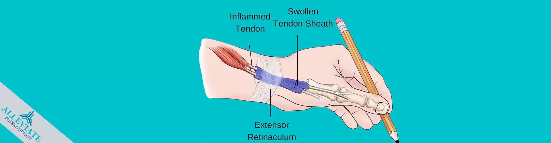 De Quervain’s Tenosynovitis