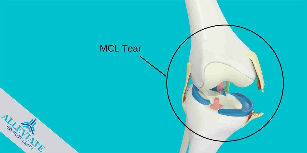 mcl tear ligament injury knee Physiotherapy