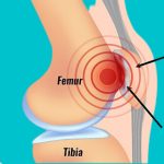 runner's knee-patellofemoral-syndrome-kneepain-mississauga-physiotherapy-etobicoke-rehabilitation