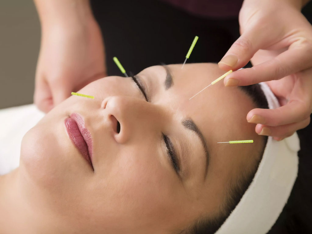 Acupuncture for Depression