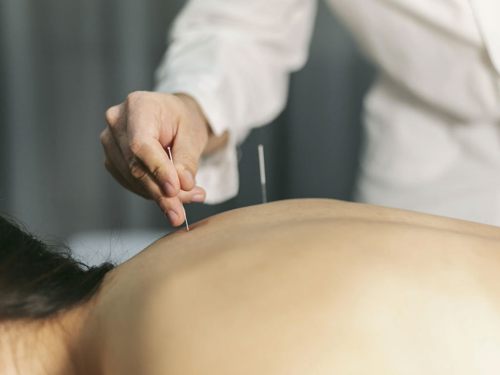 Acupuncture for Hormonal Balance