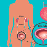 Interstitial-Cystitis-pelvichealth-pelvicfloor-physiotherapy-mississauga-etobicoke-oakville-clarkson