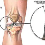 LCL Injury Alleviate Physiotherapy for Quick Recovery
