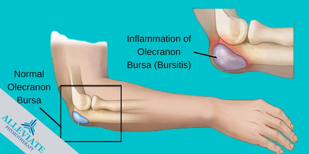 Olecranonbursitis-bursitis-elbowpain-pain-physiotherapy-etobicoke-mississauga-clarkson-oakville