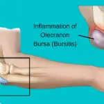 Olecranonbursitis-bursitis-elbowpain-pain-physiotherapy-etobicoke-mississauga-clarkson-oakville