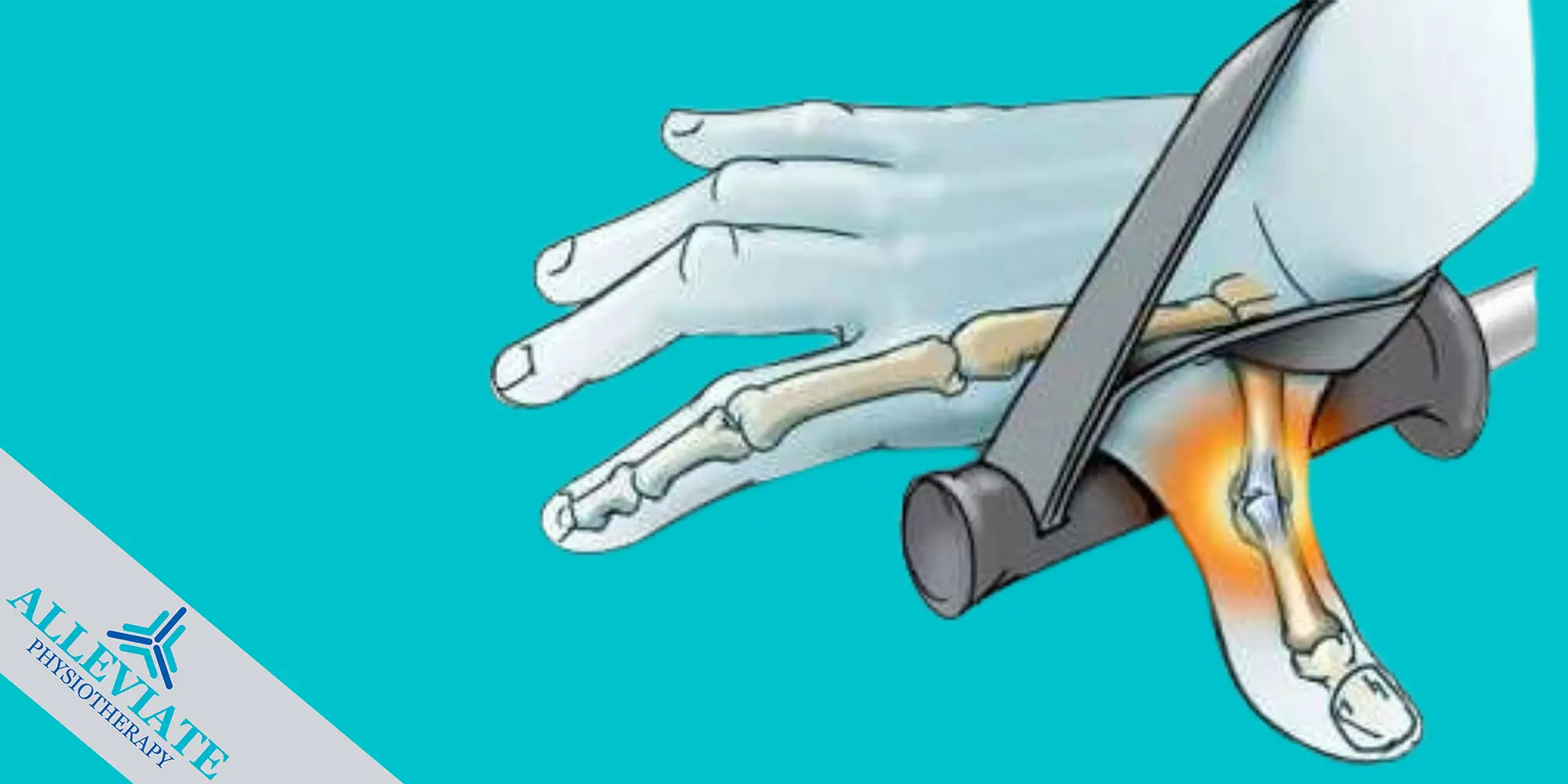 Skier’s Thumb